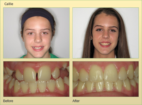 Invisalign Case