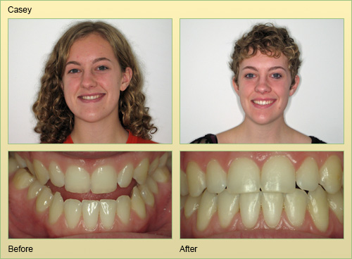 Invisalign Case