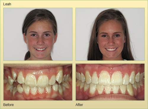 Invisalign Case