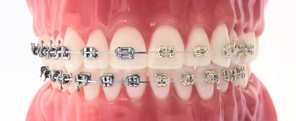 Iconix® Aesthetic Braces